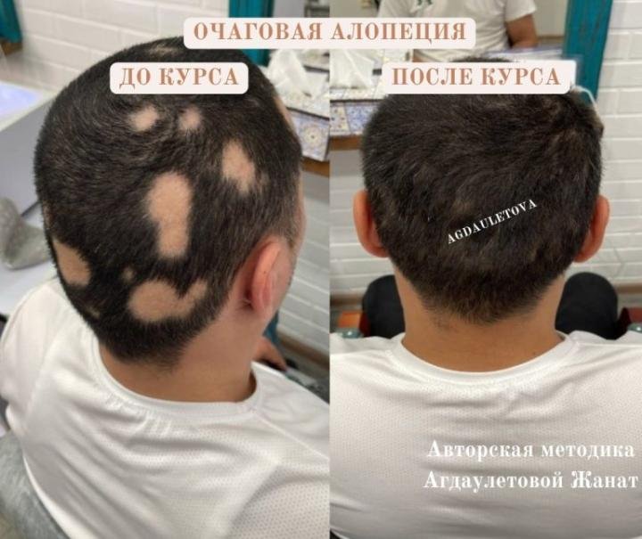 Логотип - Трихолог, лечение выпадения волос, лечение очаговой алопеции, АГА, себорея, псориаз