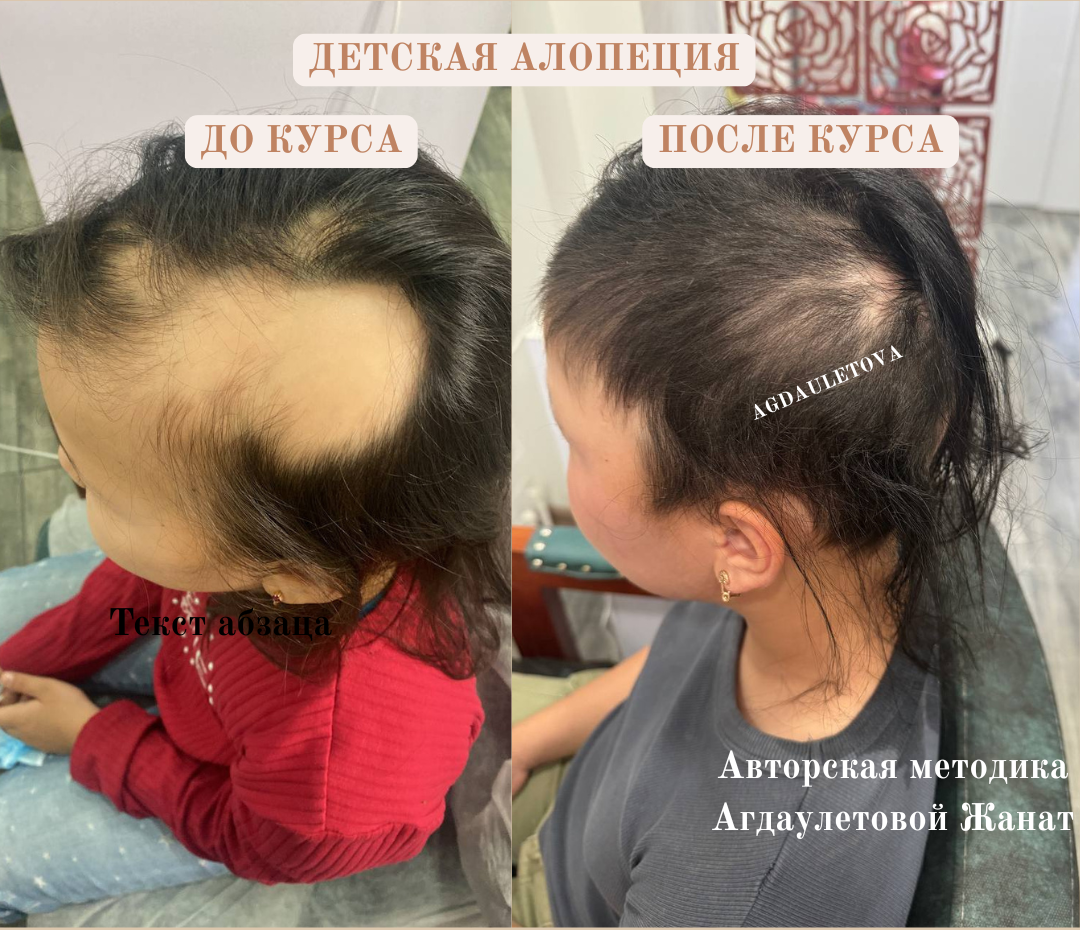 Лечение детской алопеции в Атырау, фото-1