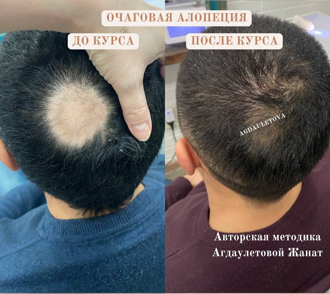 Программа «Стоп-выпадение», фото-1