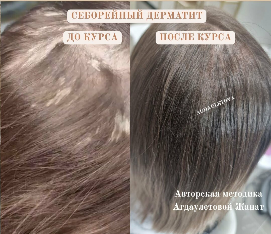 Лечение себореи и псориаза кожи головы, фото-1